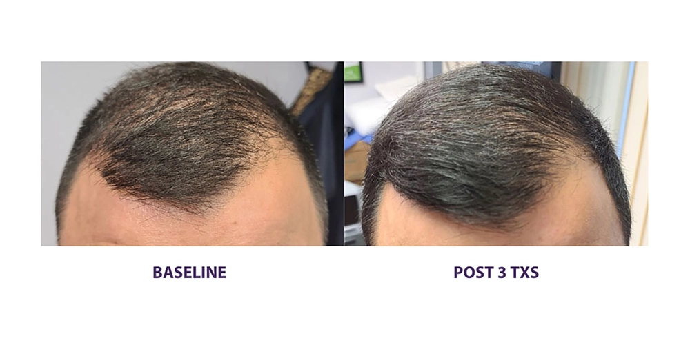 Alma TED before-after